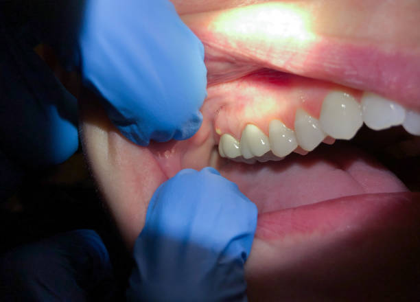 Best Emergency Dentist for Lost Fillings or Crowns in Powderly, TX